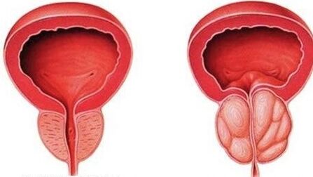 normal and inflamed prostate