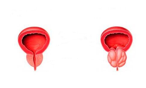 healthy and inflamed prostate with prostatitis