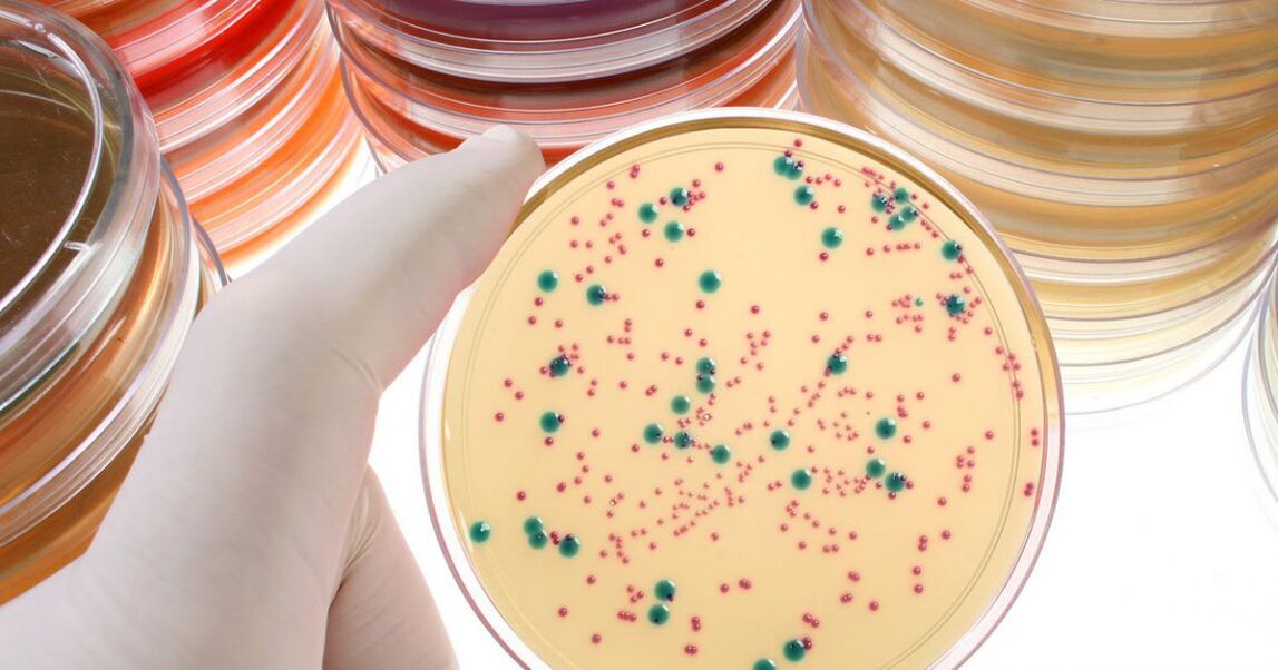 Bacterial chronic prostatitis is detected by analysis of urine and prostate secretions